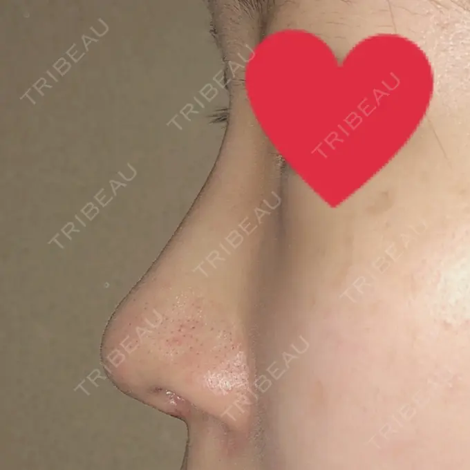 軟骨移植 / 骨切幅寄せ / ワシ鼻修正・ハンプ切除 / 鼻孔縁下降 加美（GAMI）整形外科 DAY 16 メイン用