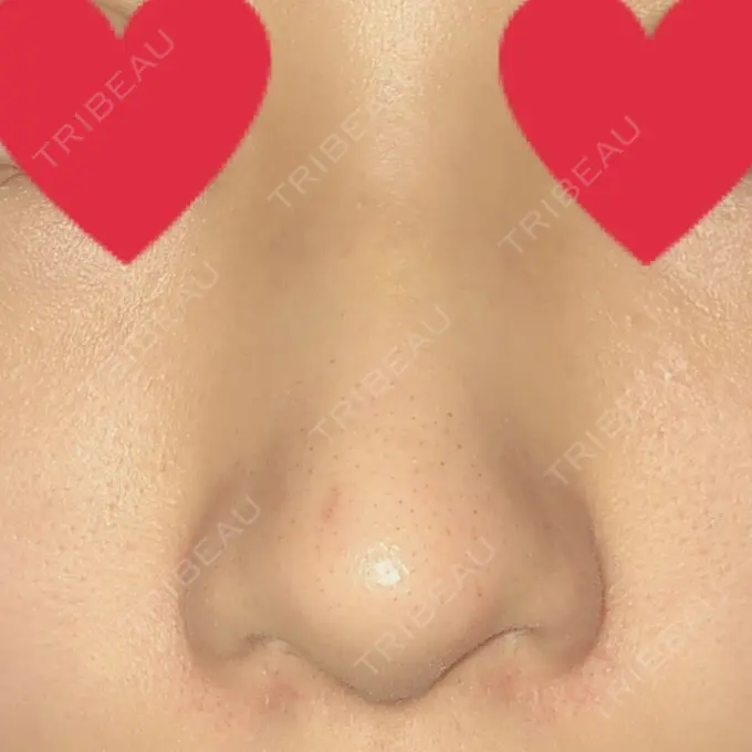 軟骨移植 / 骨切幅寄せ / ワシ鼻修正・ハンプ切除 / 鼻孔縁下降 加美（GAMI）整形外科 DAY 16 メイン用