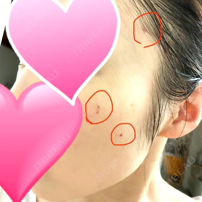 ほくろ・いぼ切除（肌） 医療法人美彩会 グランクリニック DAY 14 メイン用