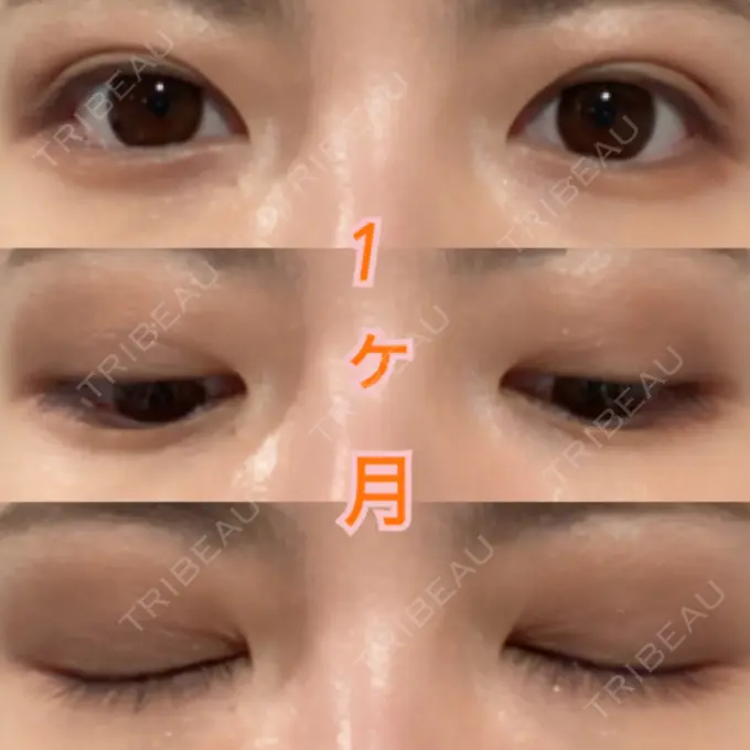 二重埋没 湘南美容クリニック 東京蒲田院 AFTER メイン用