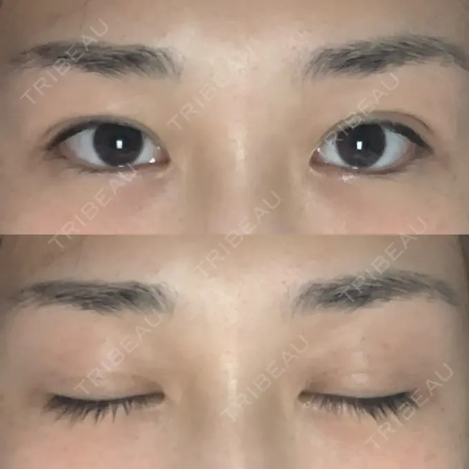 二重埋没 湘南美容クリニック 西宮北口院 DAY 31 メイン用