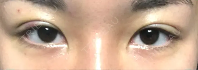 二重埋没 湘南美容クリニック 京都院 DAY 6 メイン用