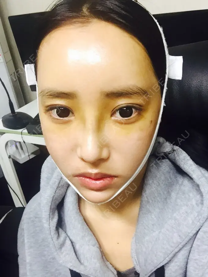 二重埋没 / 隆鼻術 / 鼻尖形成（切開） / 鼻中隔延長（切開） / 骨切り（あご） / 骨削り（エラ） / 骨削り（頬） / 軟骨移植 / ワシ鼻修正・ハンプ切除 DA美容外科 DAY 16 メイン用