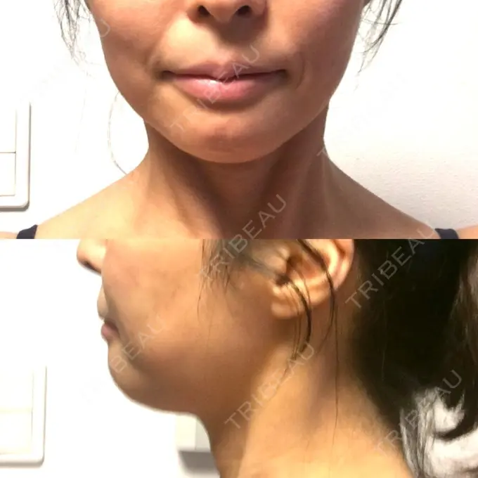 あごプロテーゼ ティーズクリニック DAY 16 メイン用