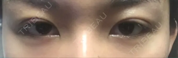 二重埋没 湘南美容クリニック 京都院 DAY 7 メイン用