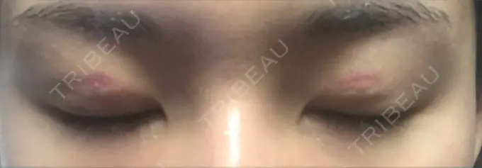 二重埋没 湘南美容クリニック 京都院 DAY 7 メイン用