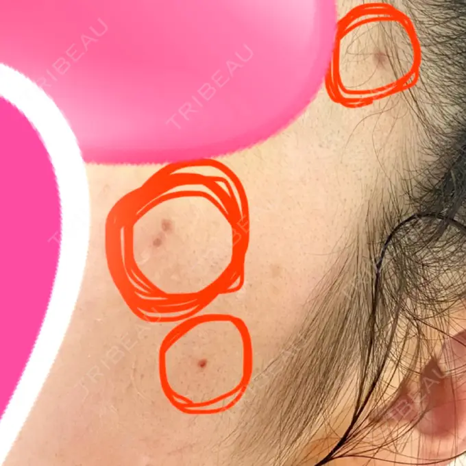 ほくろ・いぼ切除（肌） 医療法人美彩会 グランクリニック DAY 16 メイン用