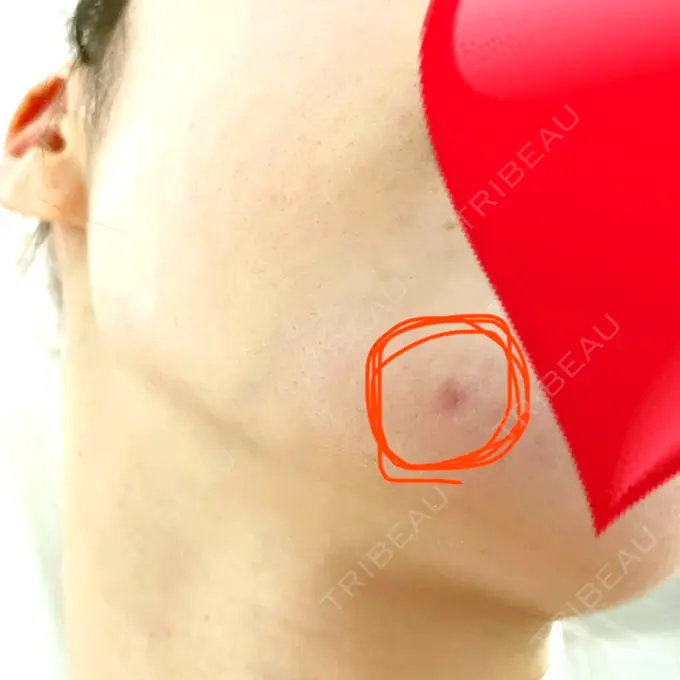 ほくろ・いぼ切除（肌） 医療法人美彩会 グランクリニック DAY 16 メイン用