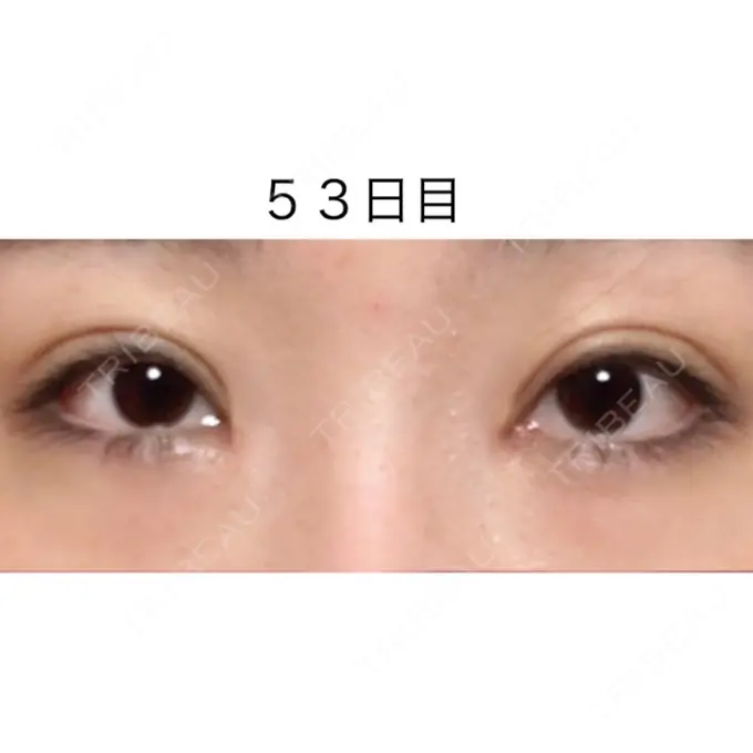 二重切開 / 目頭切開 / 眼瞼下垂（切開） / 目尻切開 / タレ目形成・グラマラスライン（切開） ジュエリー美容外科 DAY 52 メイン用