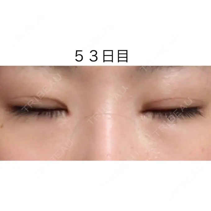 二重切開 / 目頭切開 / 眼瞼下垂（切開） / 目尻切開 / タレ目形成・グラマラスライン（切開） ジュエリー美容外科 DAY 52 メイン用