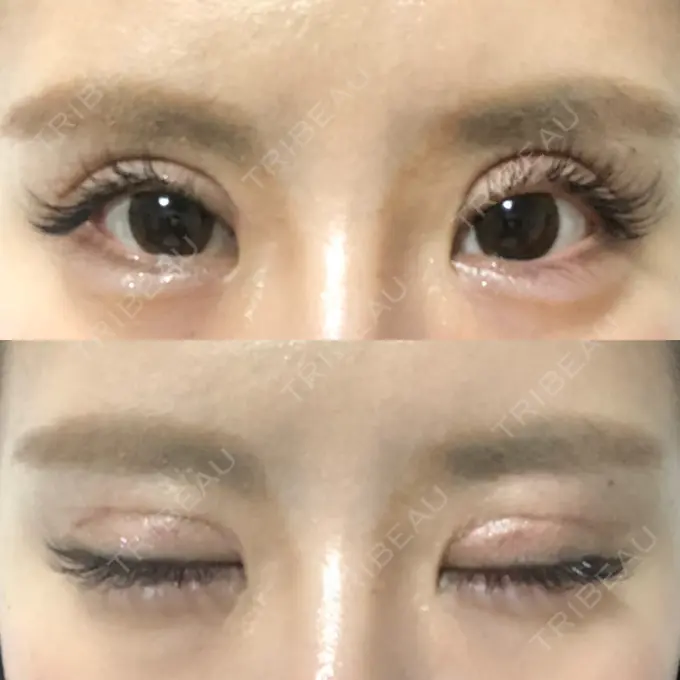 二重切開 / 目元修正 心斎橋コムロ美容外科クリニック DAY 69 メイン用