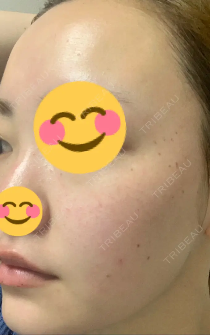 シミ取りレーザー / ピコレーザートーニング（美白・肝斑） SELECT CLINIC（セレクトクリニック） 表参道院 DAY 4 メイン用