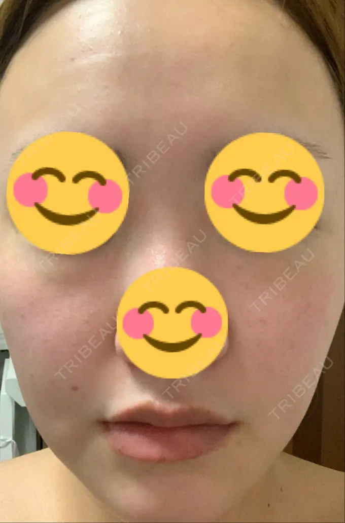 シミ取りレーザー / ピコレーザートーニング（美白・肝斑） SELECT CLINIC（セレクトクリニック） 表参道院 DAY 5 メイン用