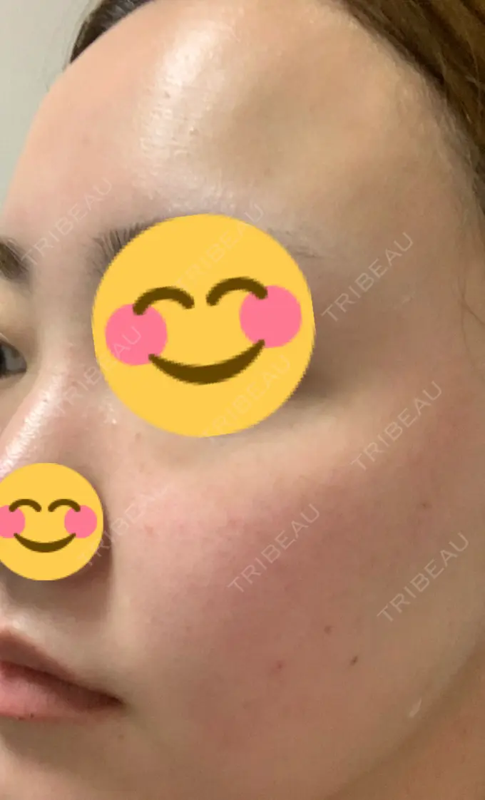 シミ取りレーザー / ピコレーザートーニング（美白・肝斑） SELECT CLINIC（セレクトクリニック） 表参道院 DAY 5 メイン用