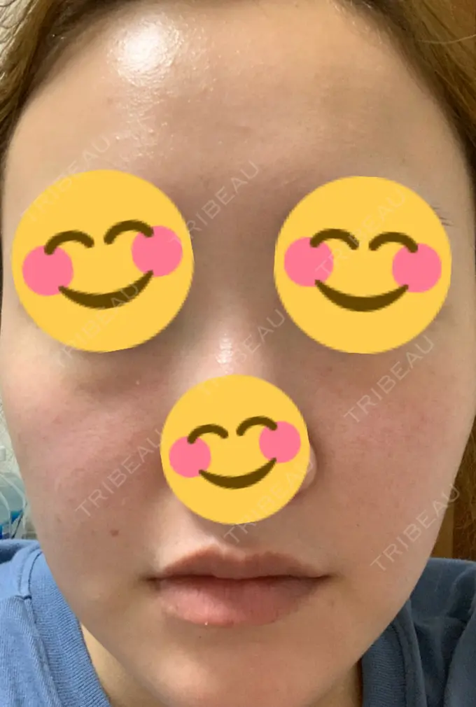 シミ取りレーザー / ピコレーザートーニング（美白・肝斑） SELECT CLINIC（セレクトクリニック） 表参道院 AFTER メイン用