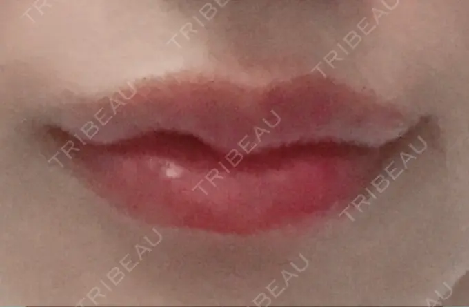 ヒアルロン酸注入（唇） / ボトックス（口角） アネシス美容クリニック DAY 0 メイン用