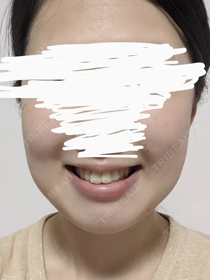 バッカルファット除去 静岡美容外科橋本クリニック DAY 2 メイン用