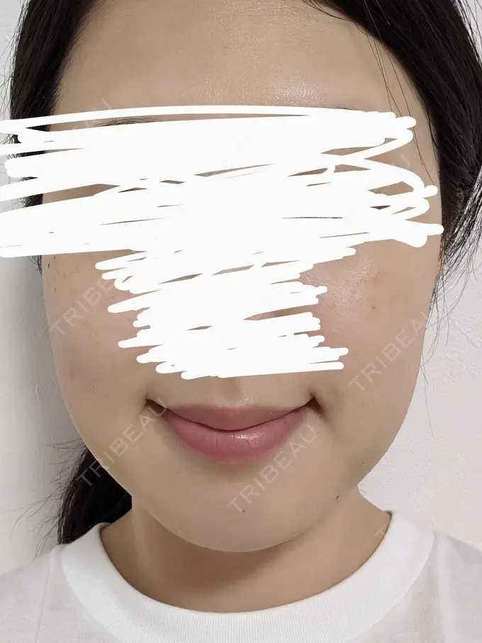 バッカルファット除去 静岡美容外科橋本クリニック DAY 3 メイン用