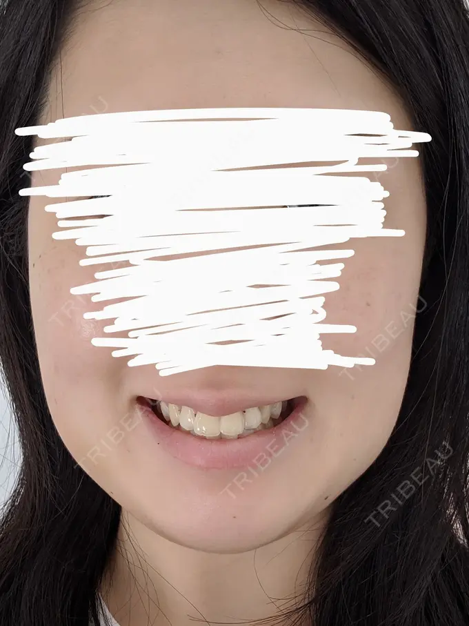 バッカルファット除去 静岡美容外科橋本クリニック DAY 4 メイン用