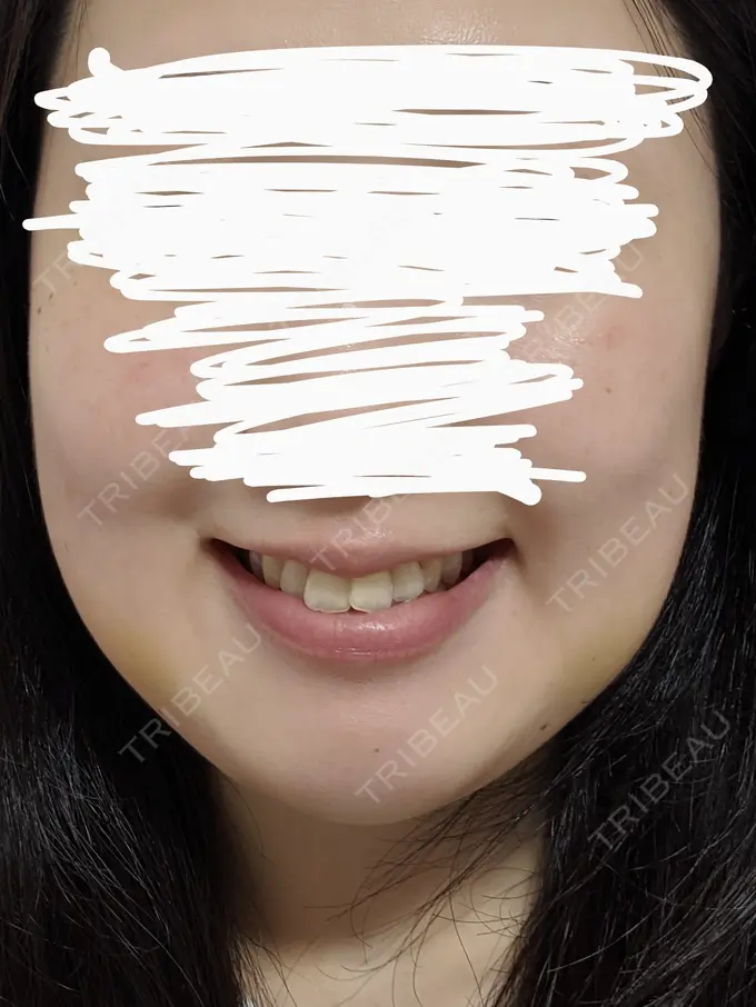 バッカルファット除去 静岡美容外科橋本クリニック DAY 5 メイン用