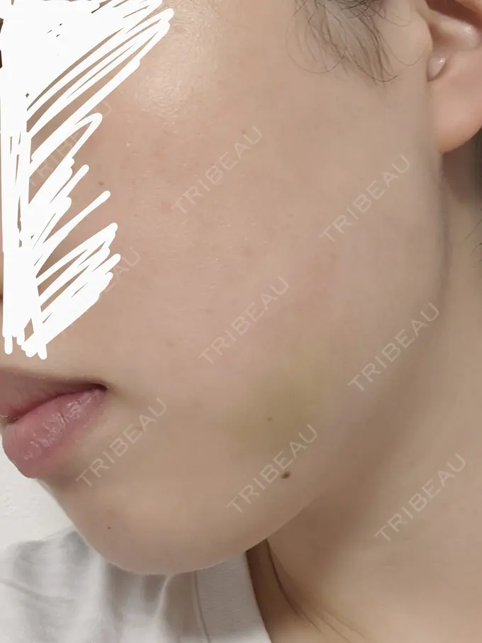 バッカルファット除去 静岡美容外科橋本クリニック DAY 5 メイン用