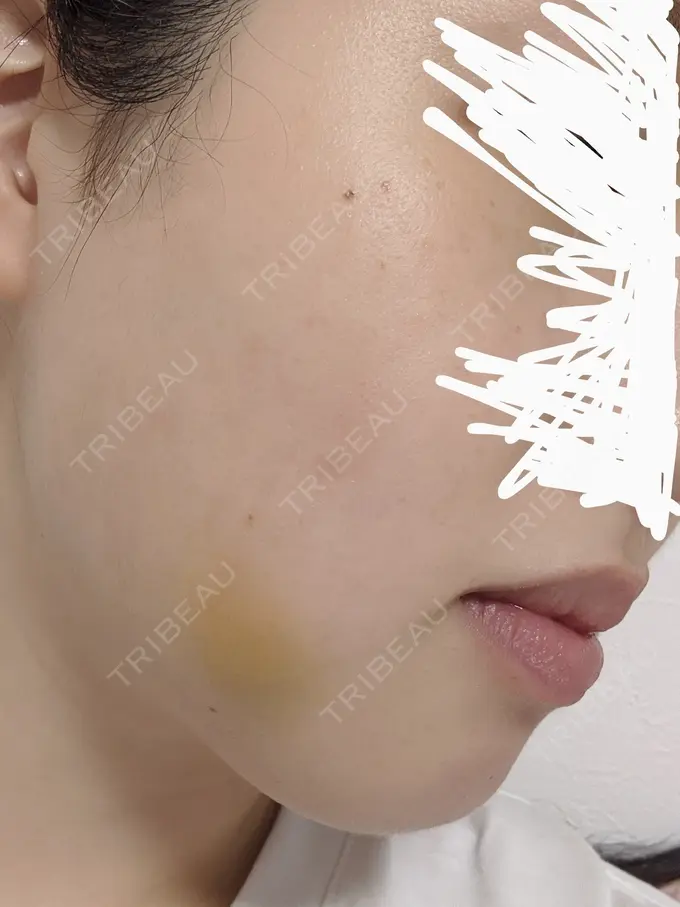 バッカルファット除去 静岡美容外科橋本クリニック DAY 5 メイン用