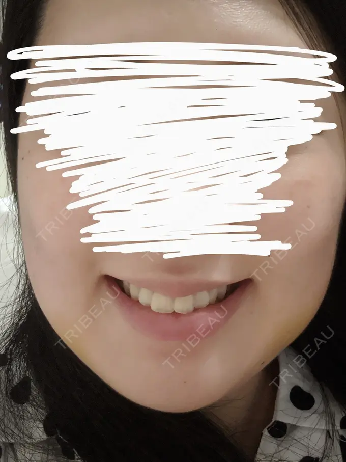 バッカルファット除去 静岡美容外科橋本クリニック DAY 7 メイン用