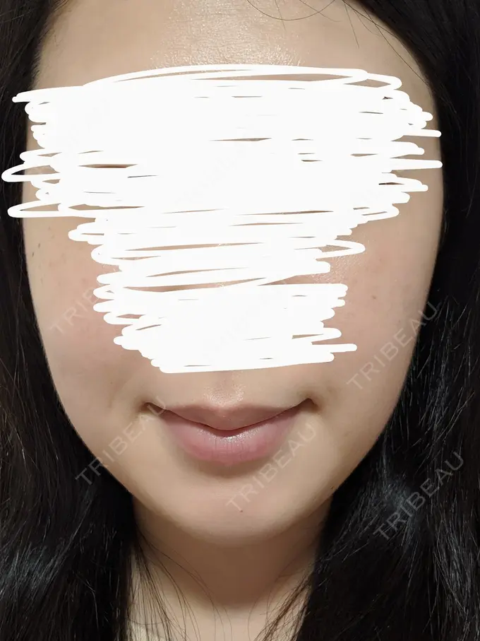 バッカルファット除去 静岡美容外科橋本クリニック AFTER メイン用