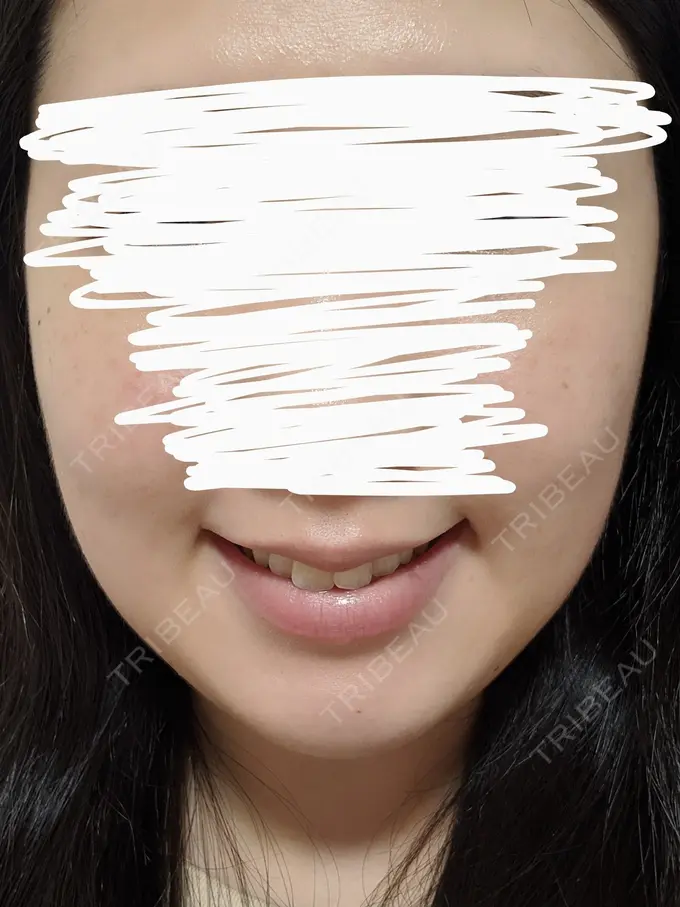 バッカルファット除去 静岡美容外科橋本クリニック DAY 13 メイン用