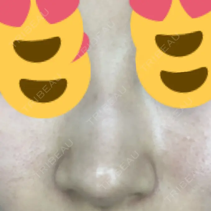 その他（鼻） ヴェリテクリニック 銀座院 DAY 0 メイン用