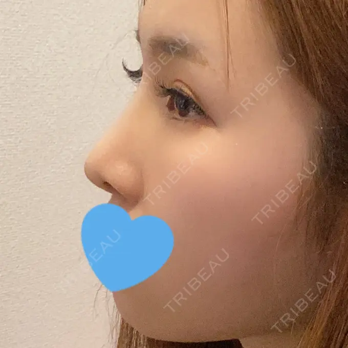 鼻尖形成（切開） / 鼻中隔延長（切開） / 軟骨移植 / 鼻孔縁下降 / その他（鼻） 湘南美容クリニック 新宿本院 DAY 16 メイン用