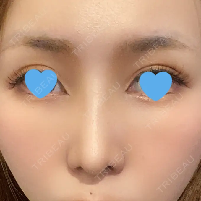 鼻尖形成（切開） / 鼻中隔延長（切開） / 軟骨移植 / 鼻孔縁下降 / その他（鼻） 湘南美容クリニック 新宿本院 DAY 16 メイン用