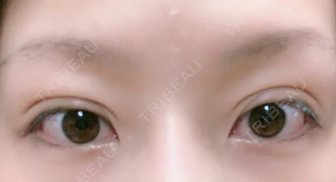 二重埋没 湘南美容クリニック 福島院 DAY 30 メイン用