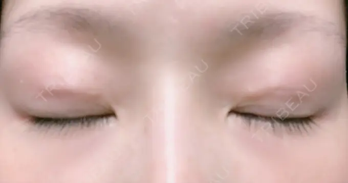 二重埋没 湘南美容クリニック 福島院 DAY 30 メイン用