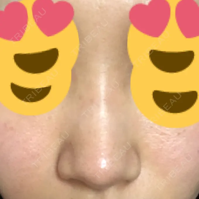 その他（鼻） ヴェリテクリニック 銀座院 DAY 1 メイン用