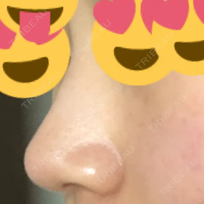 その他（鼻） ヴェリテクリニック 銀座院 DAY 1 メイン用