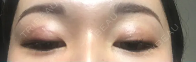 二重埋没 湘南美容クリニック 京都院 DAY 8 メイン用