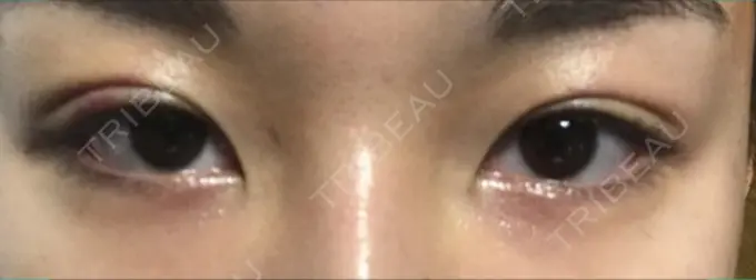 二重埋没 湘南美容クリニック 京都院 DAY 10 メイン用