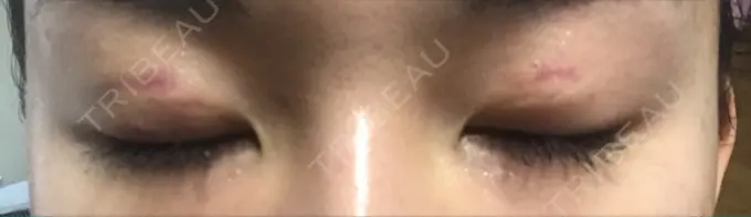 二重埋没 湘南美容クリニック 京都院 DAY 10 メイン用