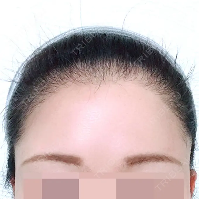 その他（肌） F5整形外科 DAY 180 メイン用