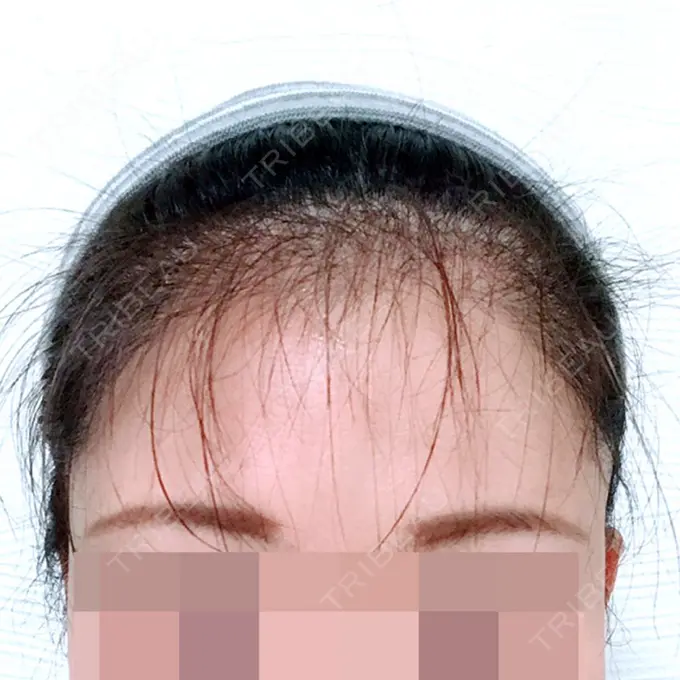 その他（肌） F5整形外科 DAY 180 メイン用