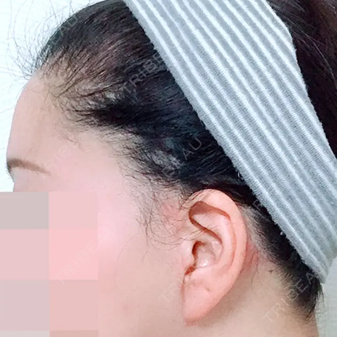 その他（肌） F5整形外科 DAY 180 メイン用