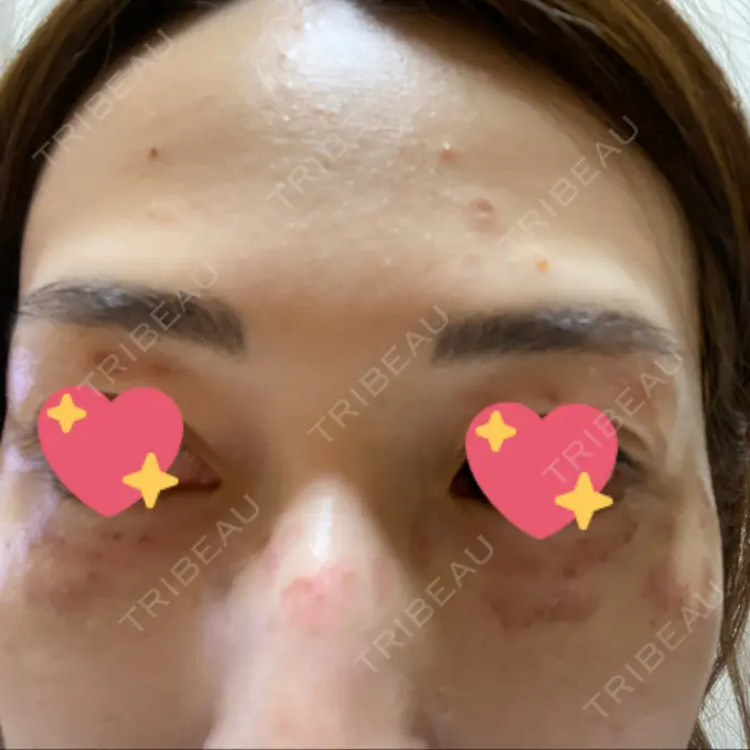 シミ取りレーザー / ピコレーザートーニング（美白・肝斑） ルラ美容クリニック 高田馬場院 DAY 2 メイン用