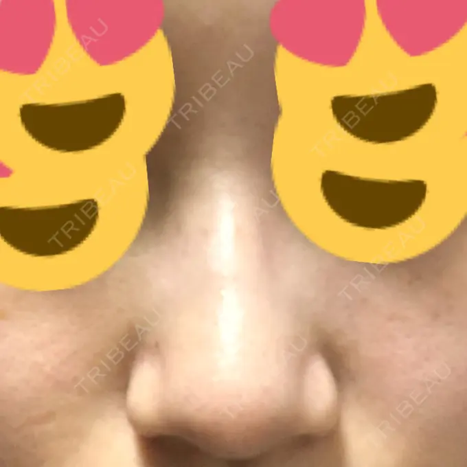 その他（鼻） ヴェリテクリニック 銀座院 AFTER メイン用