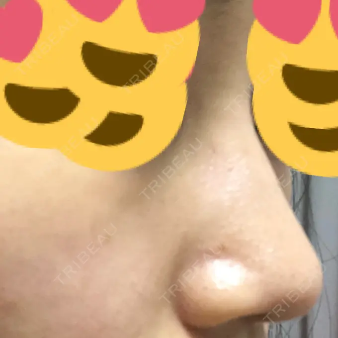 その他（鼻） ヴェリテクリニック 銀座院 DAY 2 メイン用