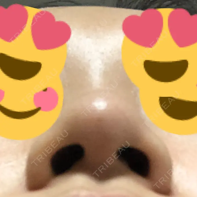 その他（鼻） ヴェリテクリニック 銀座院 DAY 2 メイン用