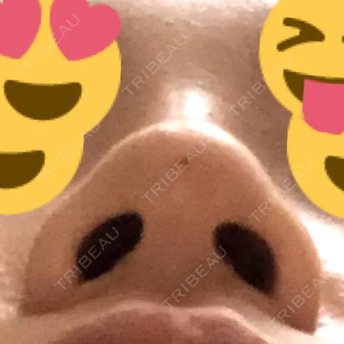 ヒアルロン酸注入（鼻） BIANCA銀座 DAY 1 メイン用