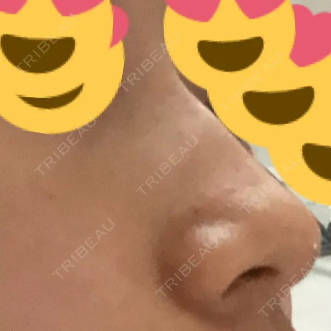 ヒアルロン酸注入（鼻） BIANCA銀座 DAY 1 メイン用