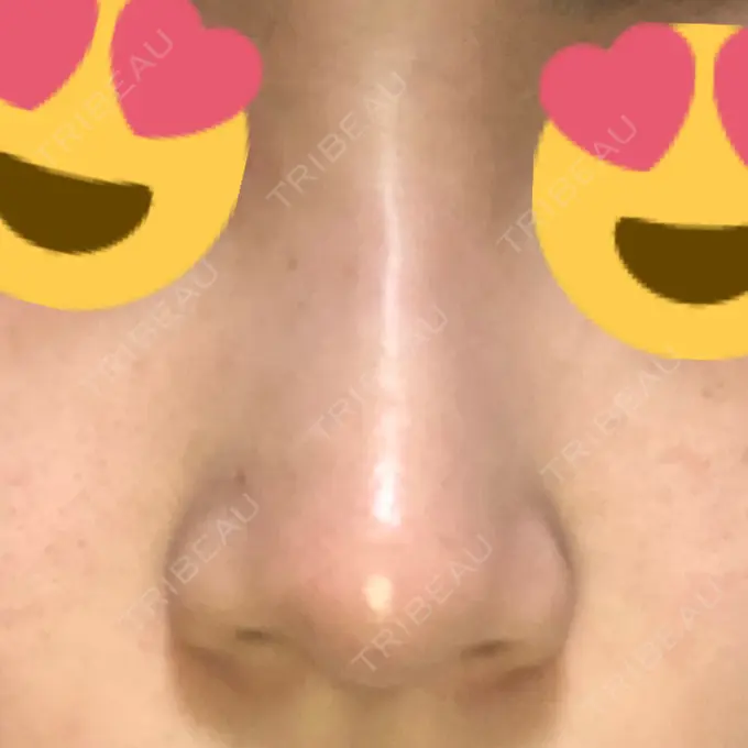 ヒアルロン酸注入（鼻） BIANCA銀座 DAY 2 メイン用