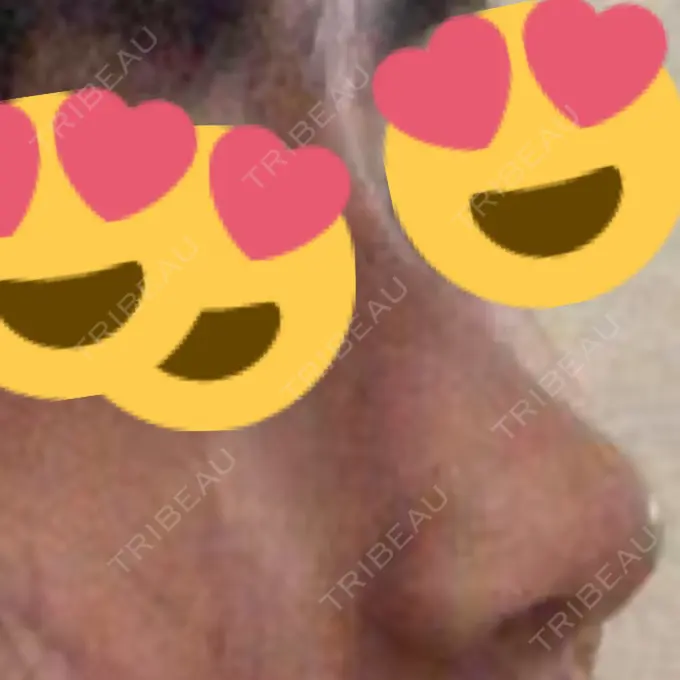 ヒアルロン酸注入（鼻） BIANCA銀座 DAY 2 メイン用